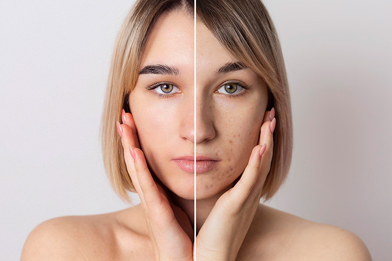 How to tackle and Treat Teenage and Adult Acne