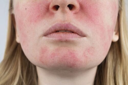 Everything you need to know about Rosacea